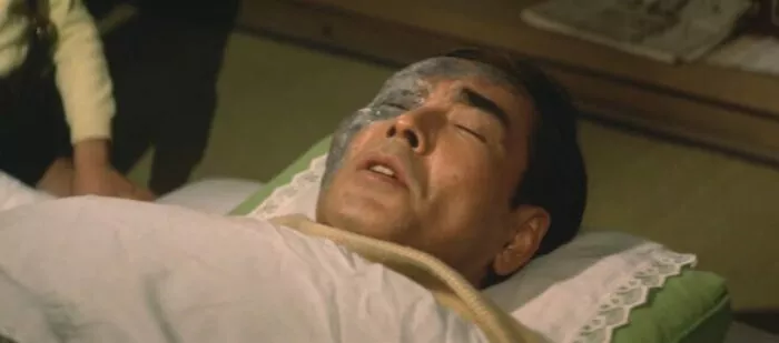 Dr. Toro Yano, burned by Hedorah, recovers at home