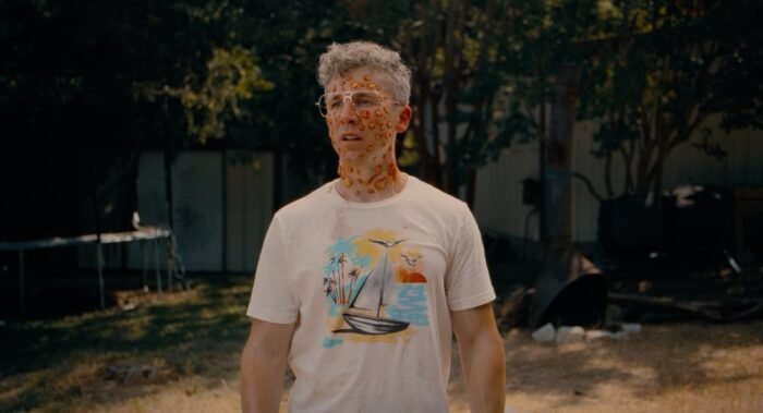 A man with multiple bug bites stands on a beach
