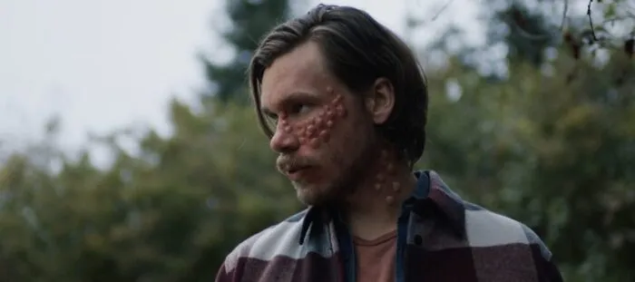 A man with boils on his face (Five)