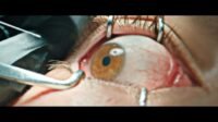 An eye is held open by surgical devices, as a needle is prepared to be inserted.